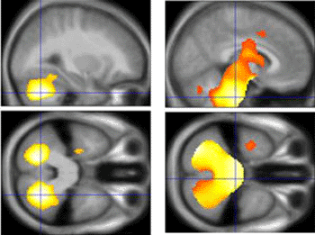 Image: Brain scans identified regions of significantly reduced gray matter (right column) and white matter (left column) in young people with Wolfram syndrome. The brainstem and the cerebellum were particularly affected (Photo courtesy of the Washington University School of Medicine in St. Louis). Image: Brain scans identified regions of significantly reduced gray matter (right column) and white matter (left column) in young people with Wolfram syndrome. The brainstem and the cerebellum were particularly affected (Photo courtesy of the Washington University School of Medicine in St. Louis).